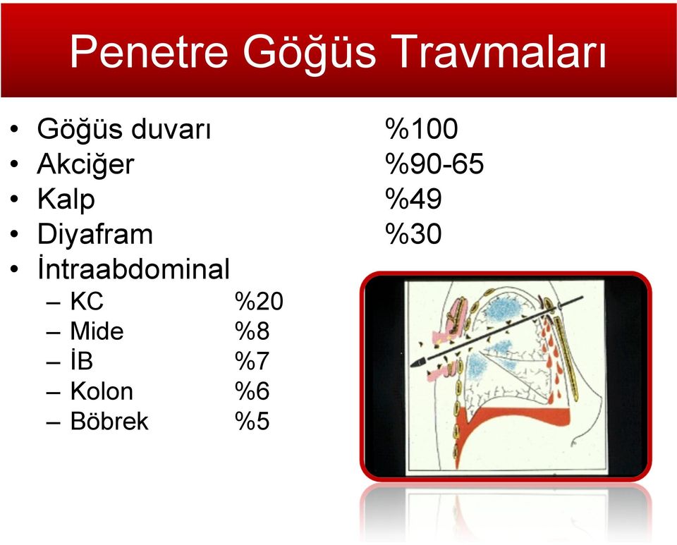 %49 Diyafram %30 İntraabdominal