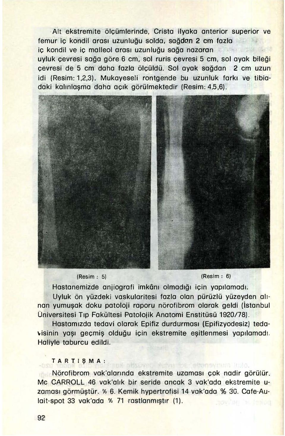 Mukayeseli rontgende bu uzunluk farkı ve tibiadaki kalınlaşma daha açık görülmektedir (Resim: 4,5,6). (Resim: 5) (Resim: 6) Hastanemizde anjiografi imkônı olmadığı için yapılamadı.