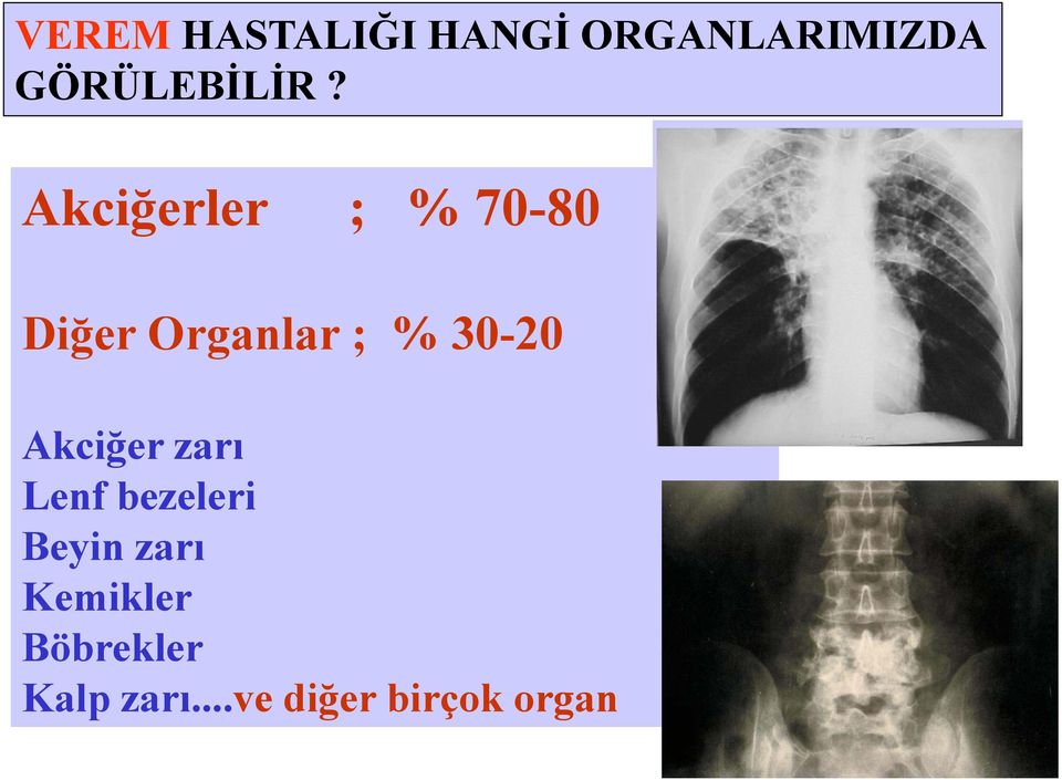 Akciğerler ; % 70-80 Diğer Organlar ; % 30-20