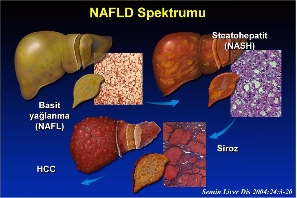 Steatohepatit (NASH) Basit