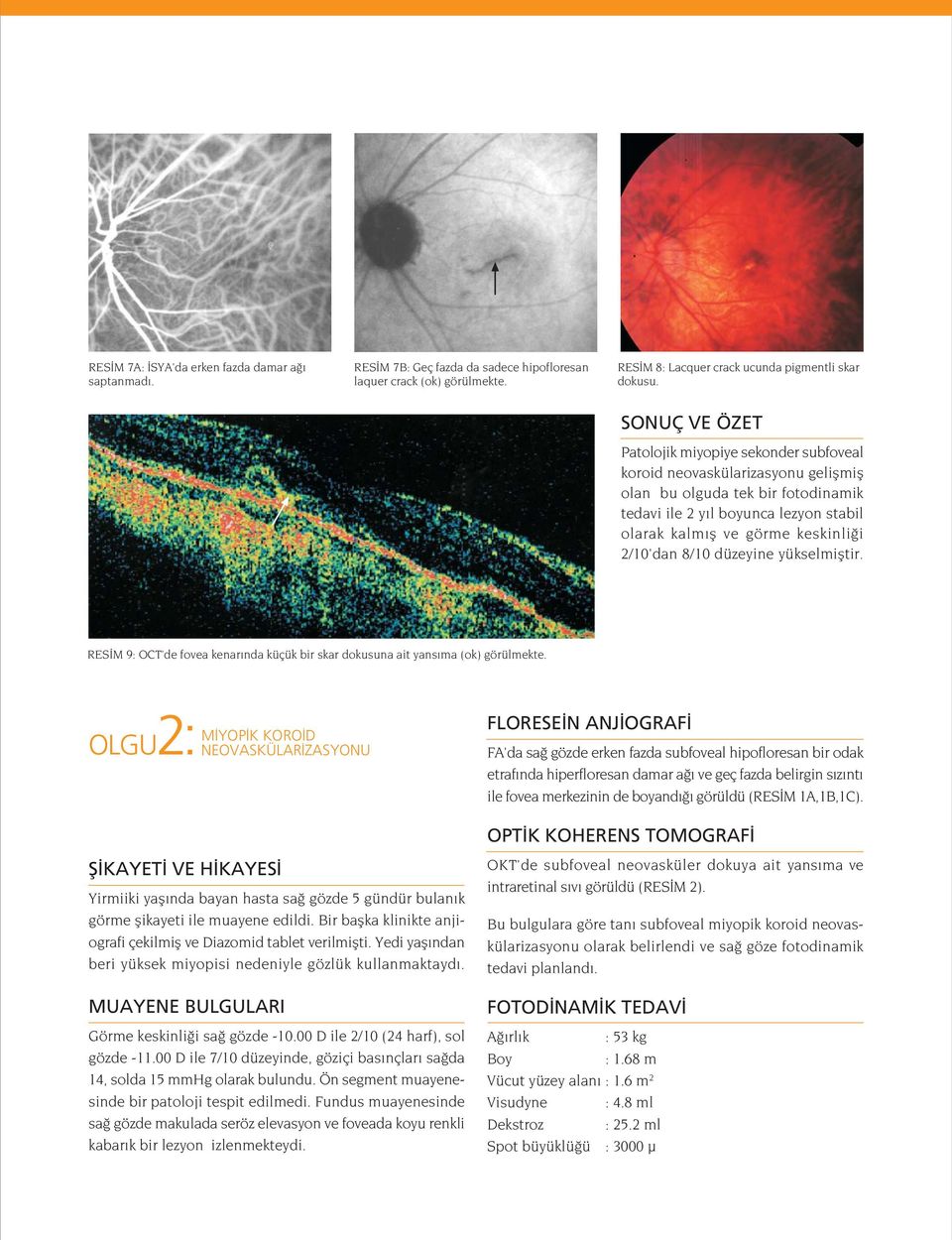 2/10'dan 8/10 düzeyine yükselmifltir. RES M 9: OCT'de fovea kenar nda küçük bir skar dokusuna ait yans ma (ok) görülmekte.