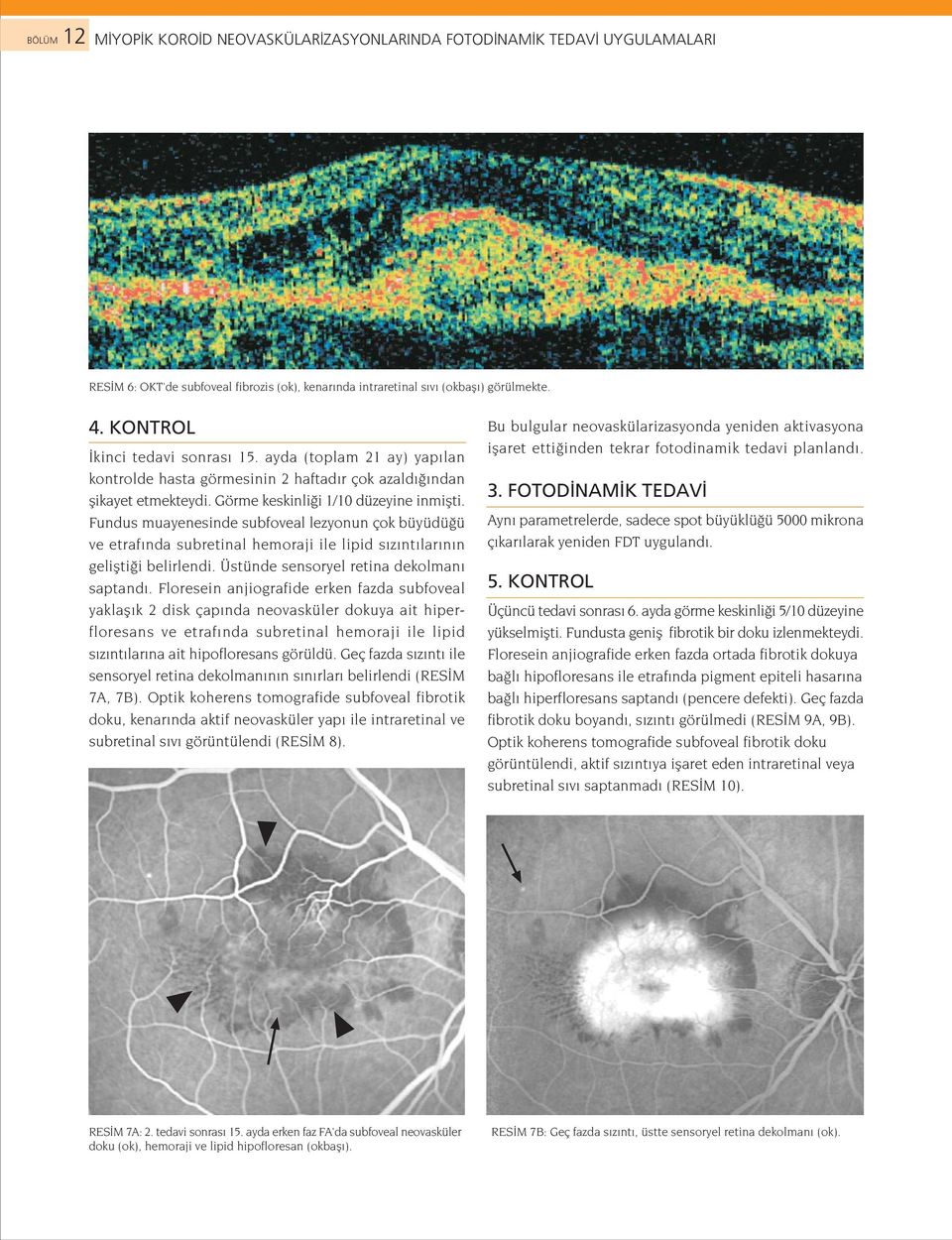 Fundus muayenesinde subfoveal lezyonun çok büyüdü ü ve etraf nda subretinal hemoraji ile lipid s z nt lar n n geliflti i belirlendi. Üstünde sensoryel retina dekolman saptand.