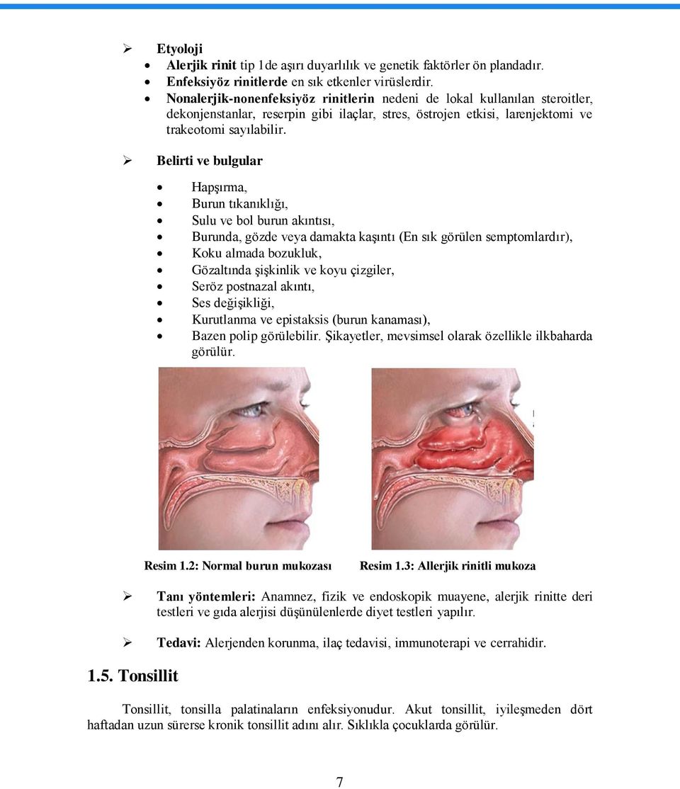 Belirti ve bulgular HapĢırma, Burun tıkanıklığı, Sulu ve bol burun akıntısı, Burunda, gözde veya damakta kaģıntı (En sık görülen semptomlardır), Koku almada bozukluk, Gözaltında ĢiĢkinlik ve koyu