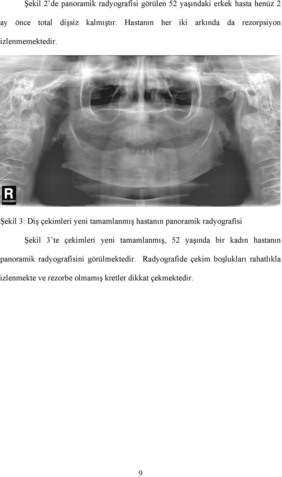 Şekil 3: Diş çekimleri yeni tamamlanmış hastanın panoramik radyografisi Şekil 3 te çekimleri yeni tamamlanmış,