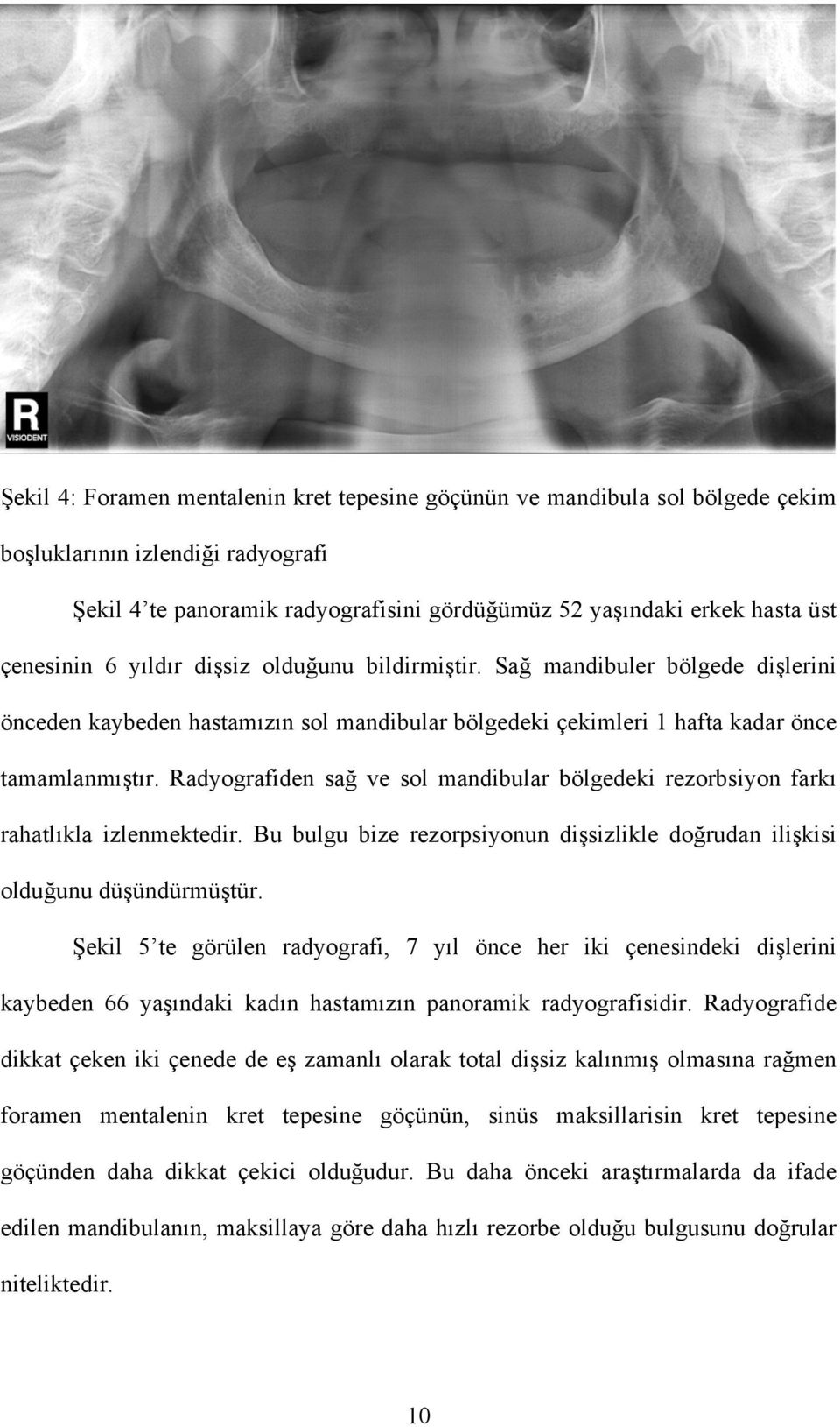 Radyografiden sağ ve sol mandibular bölgedeki rezorbsiyon farkı rahatlıkla izlenmektedir. Bu bulgu bize rezorpsiyonun dişsizlikle doğrudan ilişkisi olduğunu düşündürmüştür.