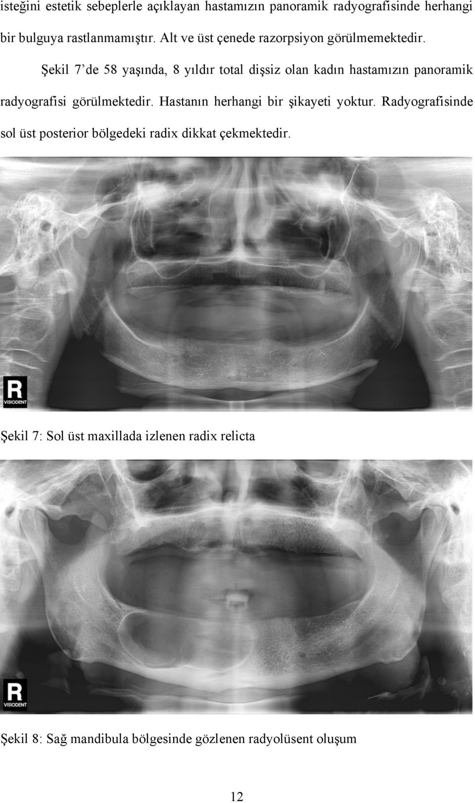 Şekil 7 de 58 yaşında, 8 yıldır total dişsiz olan kadın hastamızın panoramik radyografisi görülmektedir.