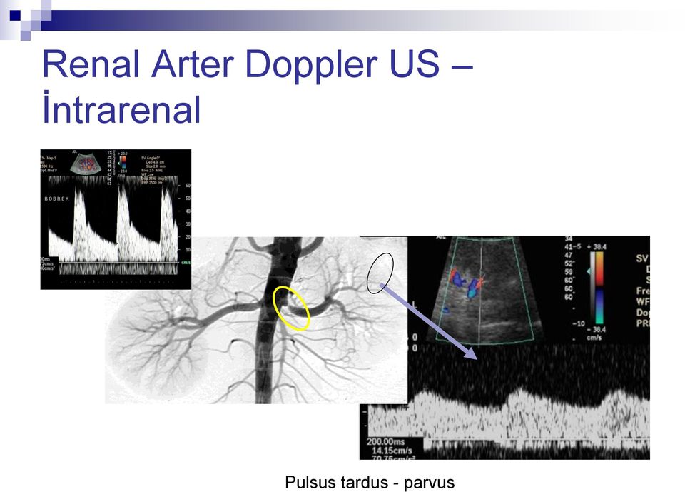 İntrarenal