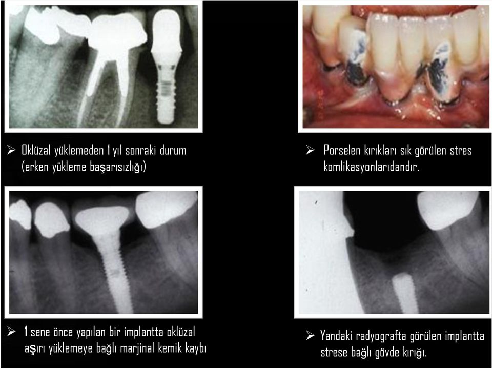 1 sene önce yapılan bir implantta oklüzal aşırı yüklemeye bağlı