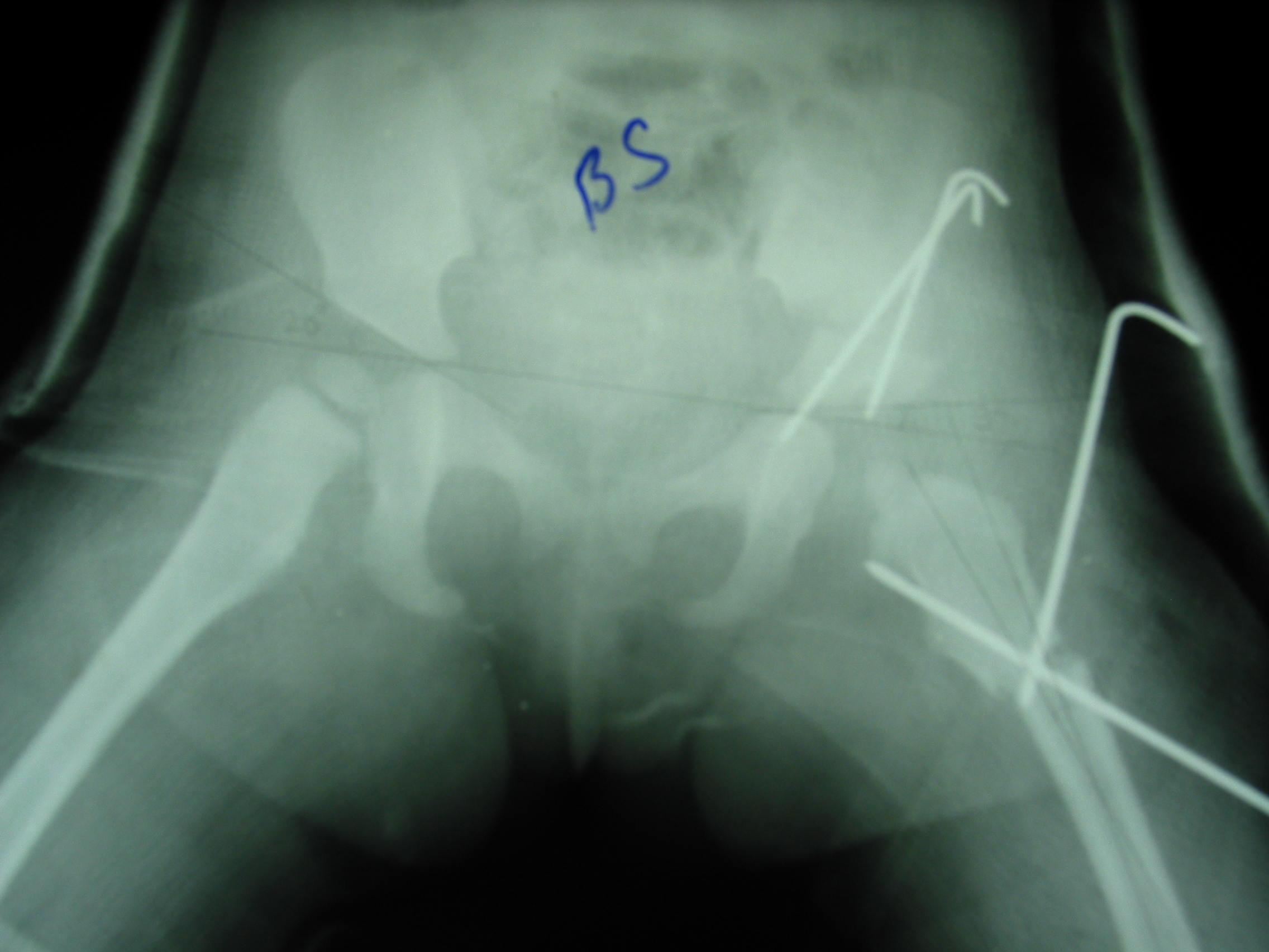 Resim 8.2. Olgunun postoperatif grafileri. Resim 8.3. Olgunun postoperatif 94. aydaki grafisi. Ç.K. / 7 yaş / Kız Prot. No:.