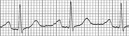 QRS aralığını ölçelim 0.