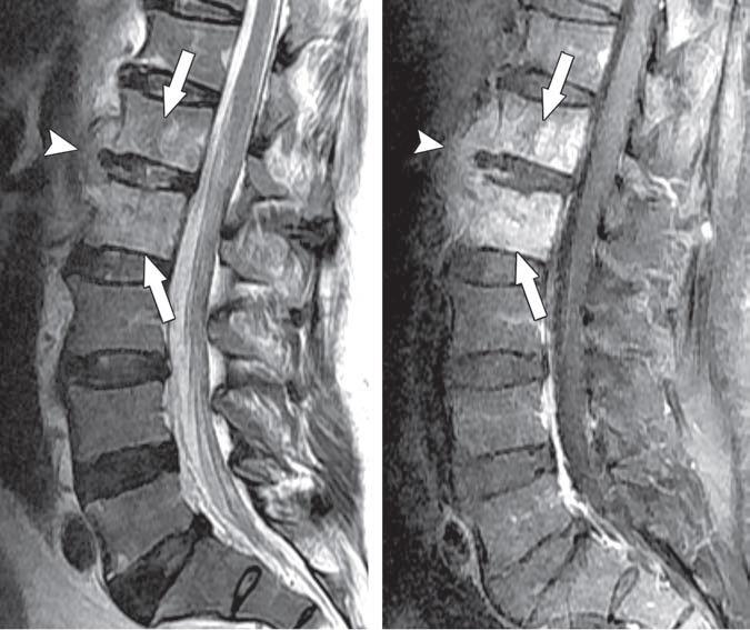 Brusella L1-L2 de vertebra korpusunda tutulum ve anterior
