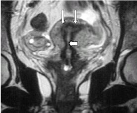 Uterus MRI