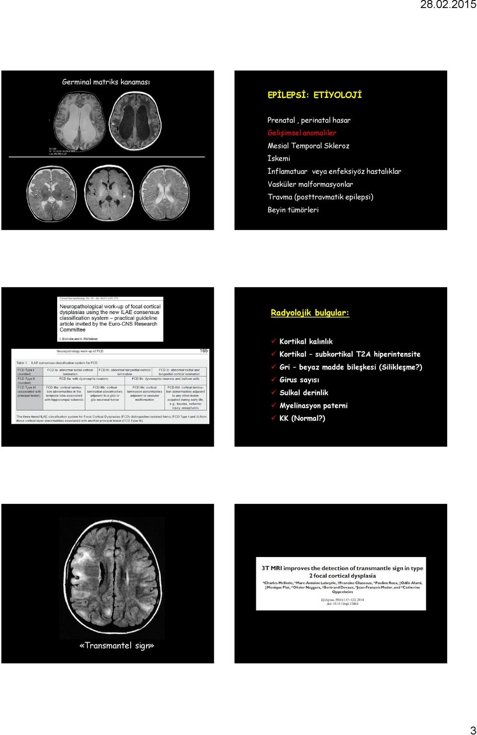 epilepsi) Beyin tümörleri Radyolojik bulgular: Kortikal kalınlık Kortikal subkortikal T2A hiperintensite Gri