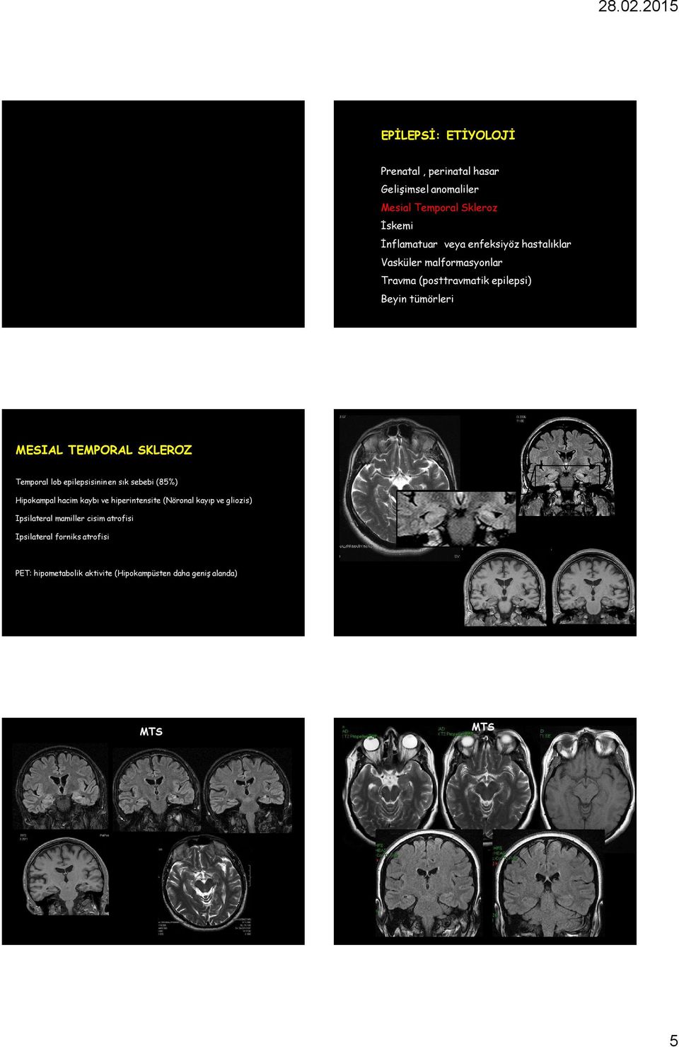 Temporal lob epilepsisinin en sık sebebi (85%) Hipokampal hacim kaybı ve hiperintensite (Nöronal kayıp ve gliozis)