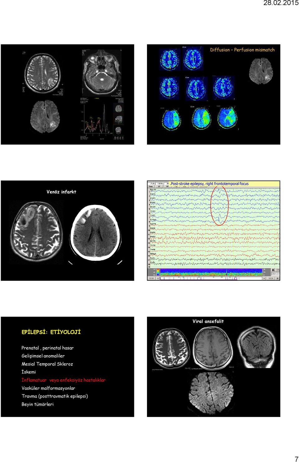 ETİYOLOJİ Prenatal, perinatal hasar Gelişimsel anomaliler Mesial Temporal Skleroz İskemi