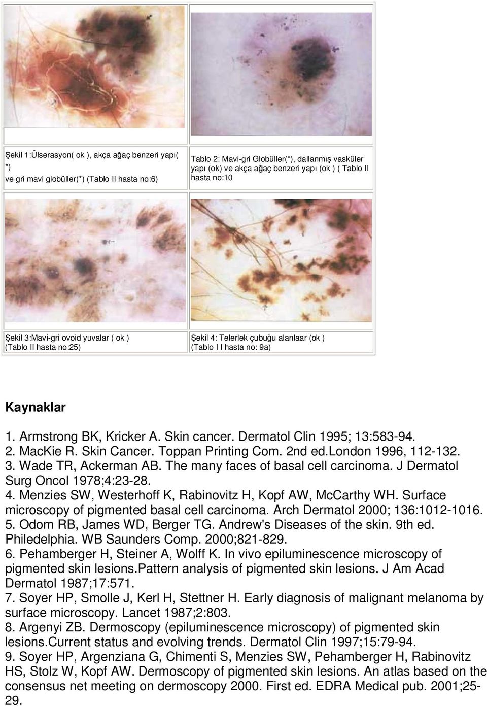 Dermatol Clin 1995; 13:583-94. 2. MacKie R. Skin Cancer. Toppan Printing Com. 2nd ed.london 1996, 112-132. 3. Wade TR, Ackerman AB. The many faces of basal cell carcinoma.