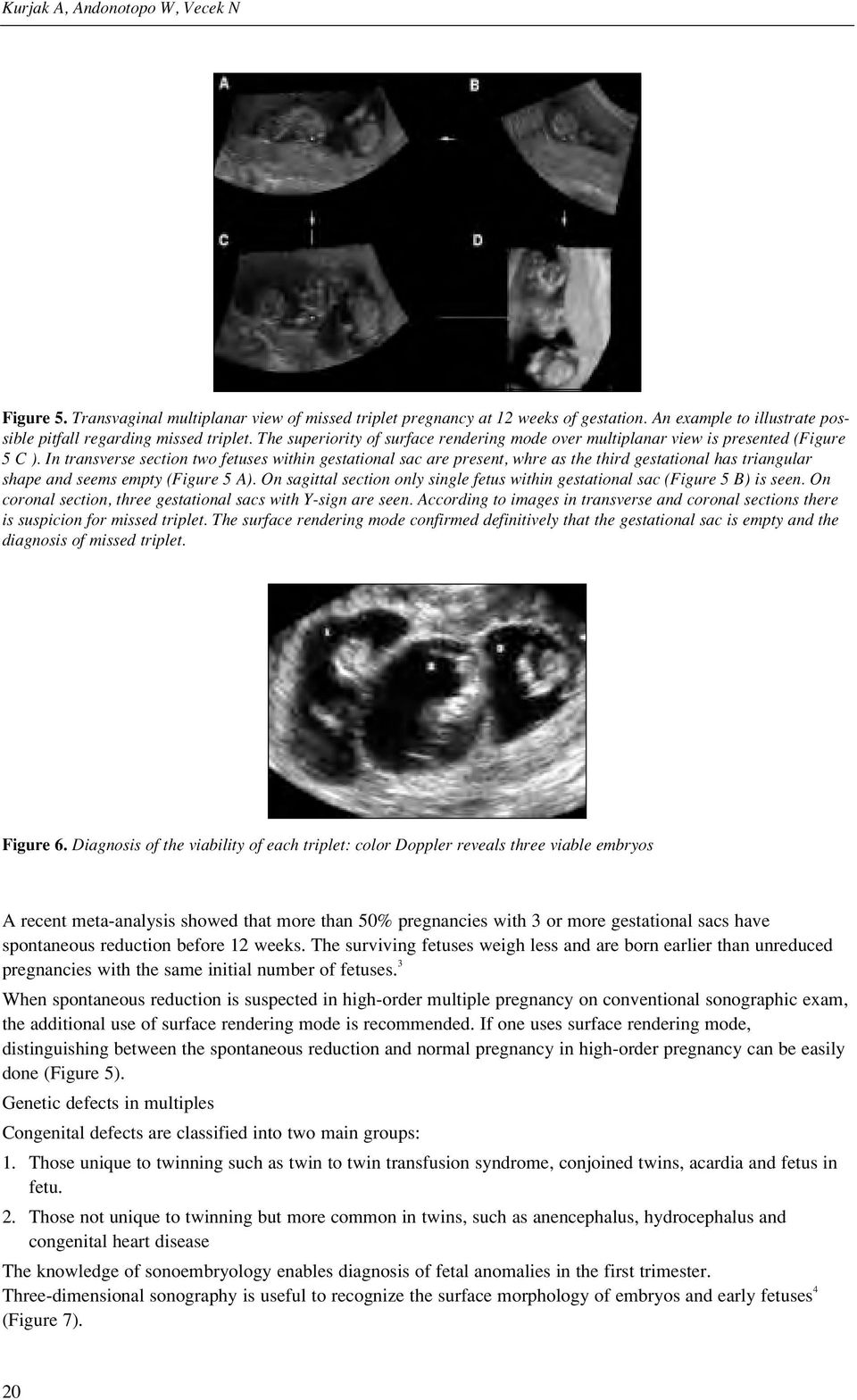 In transverse section two fetuses within gestational sac are present, whre as the third gestational has triangular shape and seems empty (Figure 5 A).
