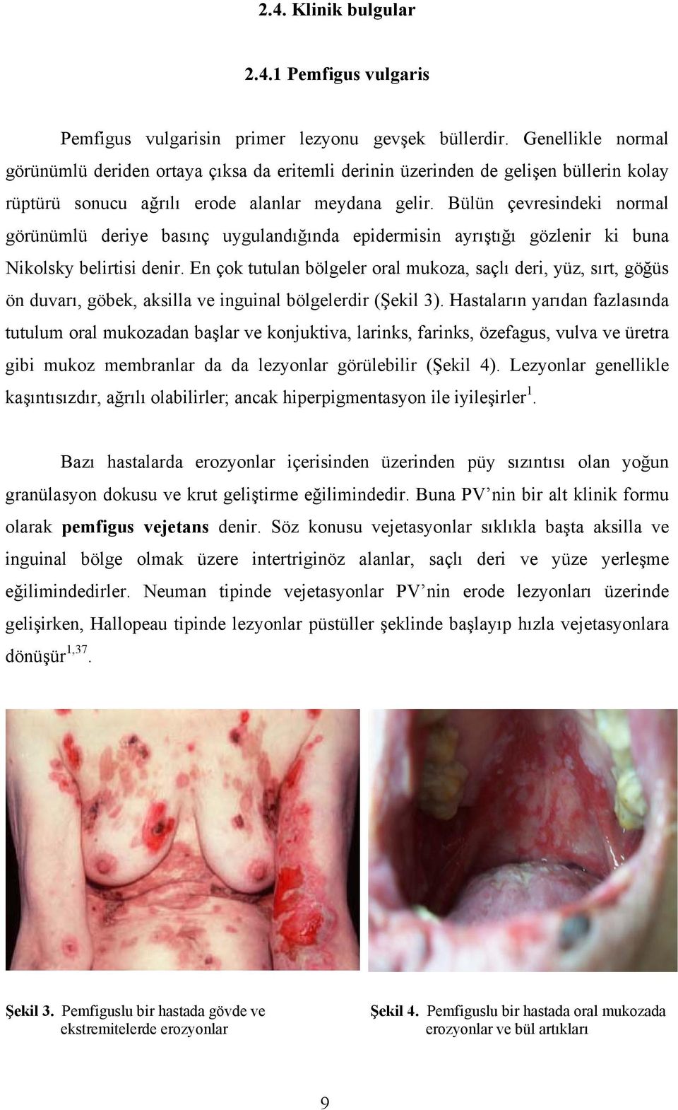 Bülün çevresindeki normal görünümlü deriye basınç uygulandığında epidermisin ayrıştığı gözlenir ki buna Nikolsky belirtisi denir.