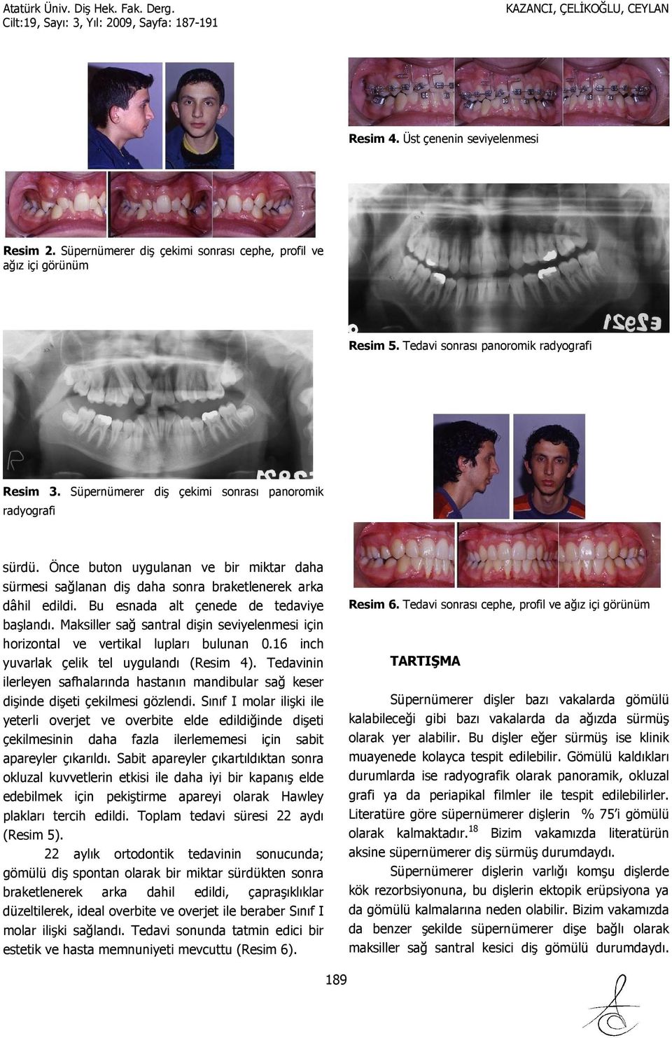 Bu esnada alt çenede de tedaviye başlandı. Maksiller sağ santral dişin seviyelenmesi için horizontal ve vertikal lupları bulunan 0.16 inch yuvarlak çelik tel uygulandı (Resim 4).