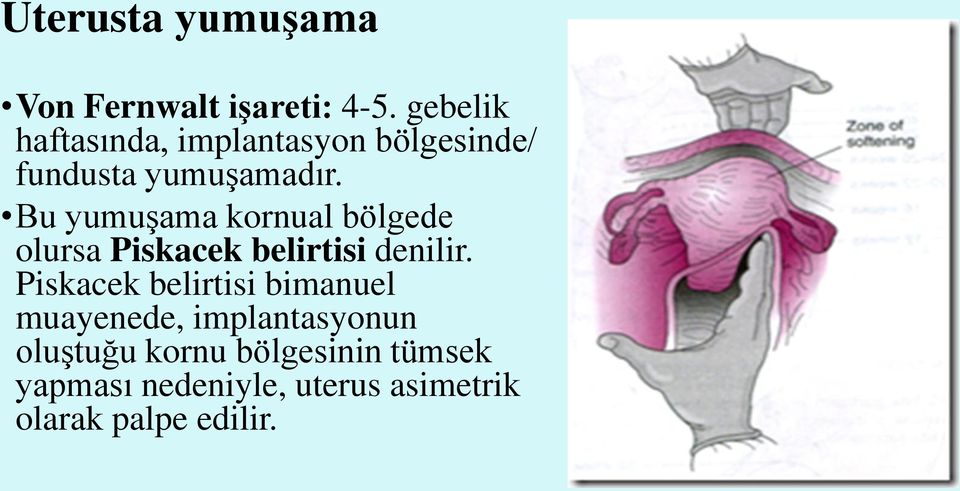 Bu yumuşama kornual bölgede olursa Piskacek belirtisi denilir.