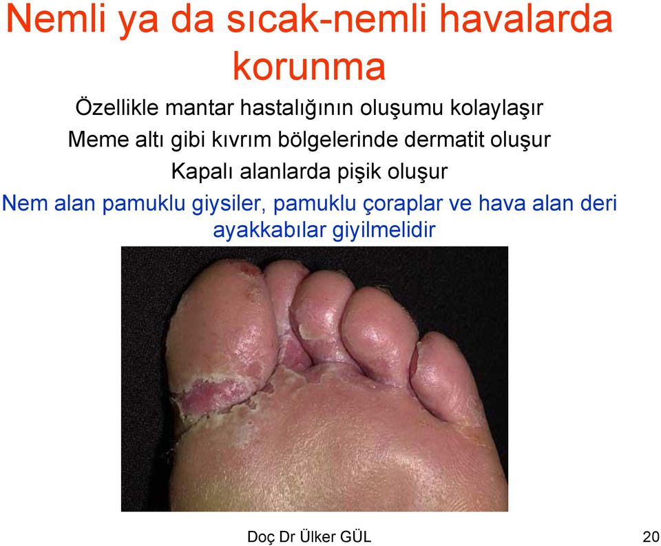 dermatit oluşur Kapalı alanlarda pişik oluşur Nem alan pamuklu