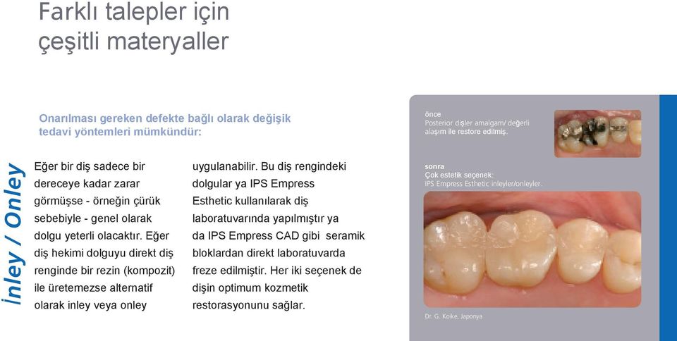 Eğer diş hekimi dolguyu direkt diş renginde bir rezin (kompozit) ile üretemezse alternatif olarak inley veya onley uygulanabilir.