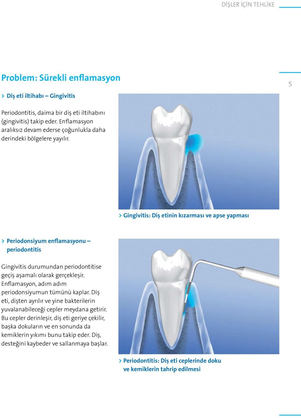 > Gingivitis: Diş etinin kızarması ve apse yapması > Periodonsiyum enflamasyonu periodontitis Gingivitis durumundan periodontitise geçiş aşamalı olarak gerçekleşir.