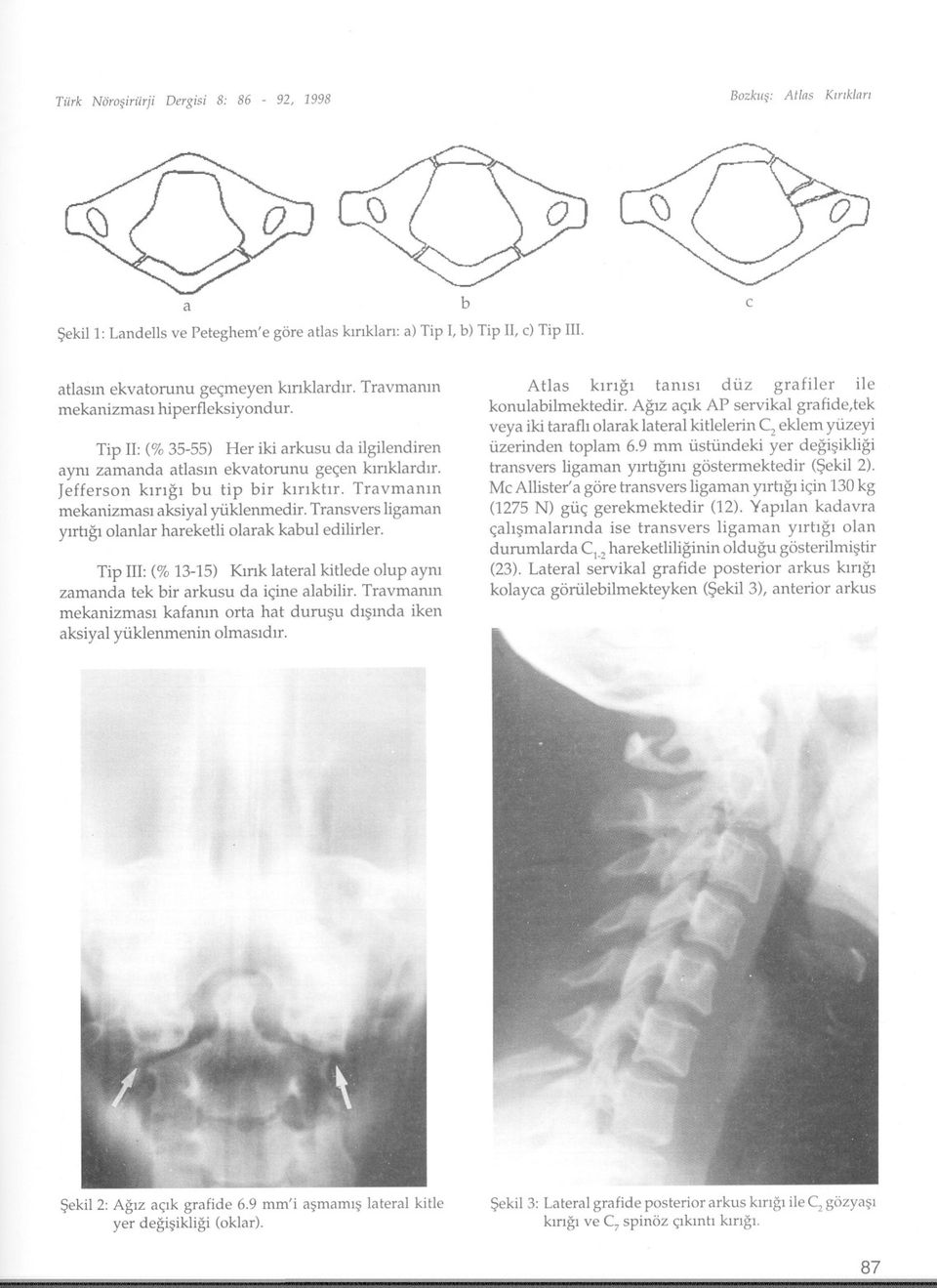 Travmanm mekanizmasl aksiyal yiiklenmedir. Transvers ligaman Ylrbgl olanlar hareketli olarak kabul edilirler. Tip ll: (% 13-15) Kmk lateral kitlede olup aym zamanda tek bir arkusu da i<;ine alabilir.