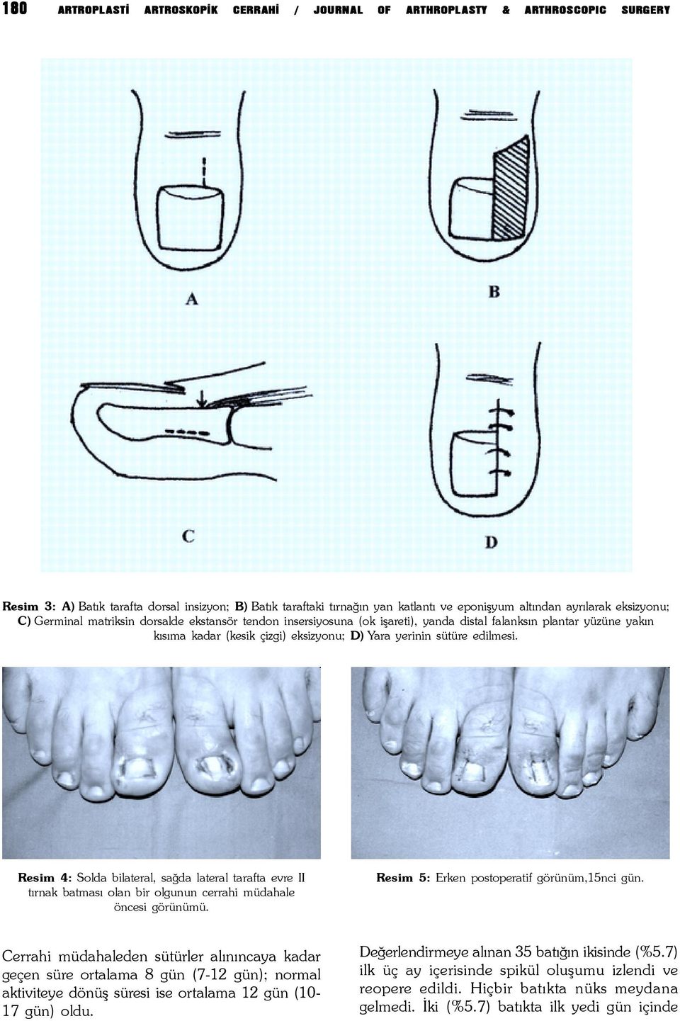 sütüre edilmesi. Resim 4: Solda bilateral, saðda lateral tarafta evre II týrnak batmasý olan bir olgunun cerrahi müdahale öncesi görünümü. Resim 5: Erken postoperatif görünüm,15nci gün.