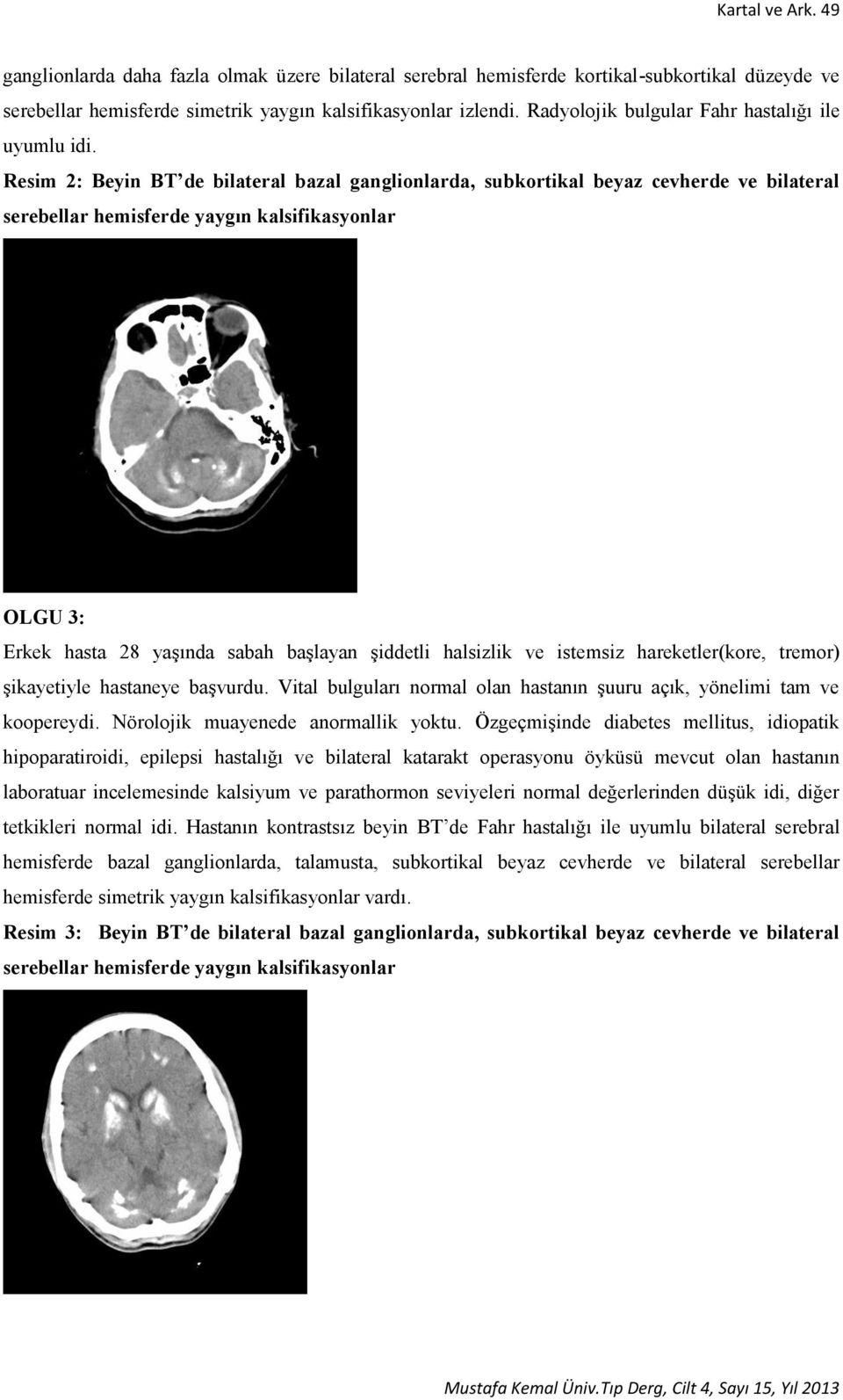 Resim 2: Beyin BT de bilateral bazal ganglionlarda, subkortikal beyaz cevherde ve bilateral serebellar hemisferde yaygın kalsifikasyonlar OLGU 3: Erkek hasta 28 yaşında sabah başlayan şiddetli