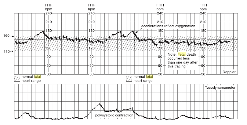 Fetal atım paterni karakteristik değil ve prognozu