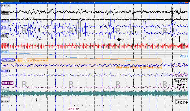 REM; 12 CMH20