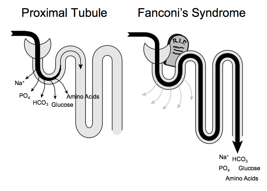 Proksimal RTA- Daha çok Fankoni sendromu görülür Fankoni sendromu: Dominant Resesif Sekonder