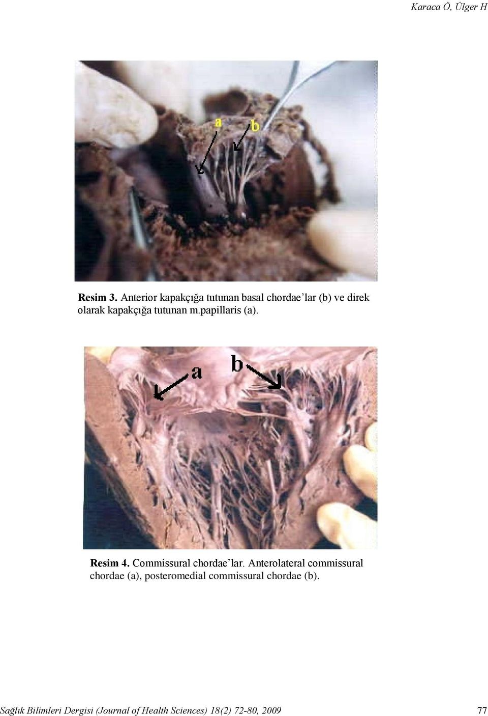 Anterior kapakçığa tutunan basal chordae lar (b) ve direk olarak kapakçığa tutunan m.papillaris (a).