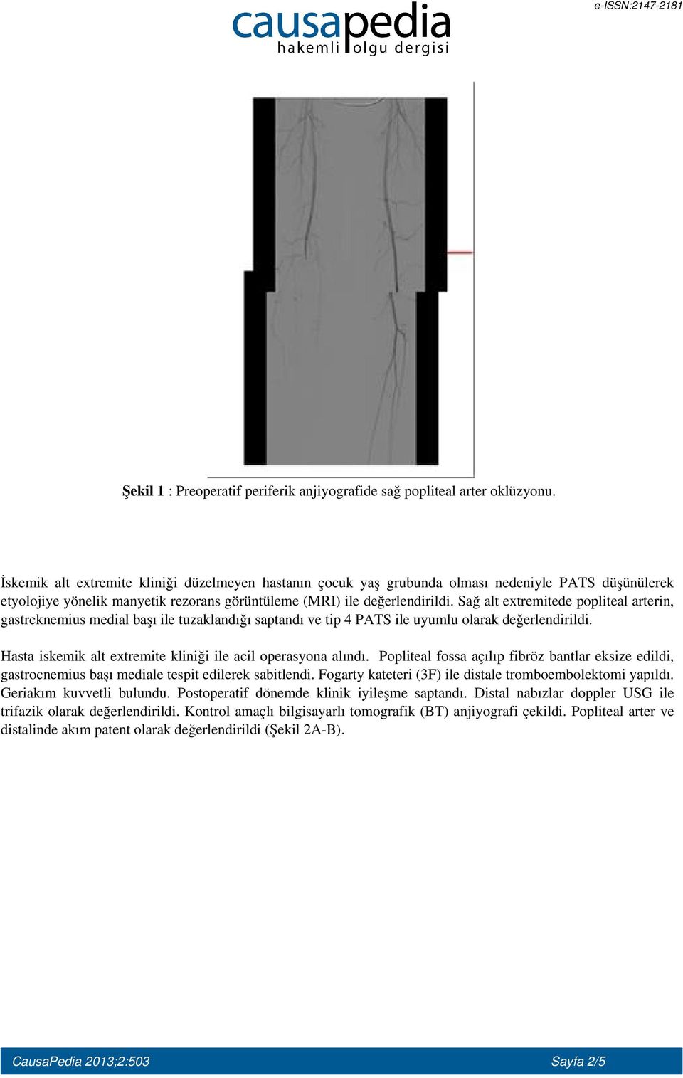 Sağ alt extremitede popliteal arterin, gastrcknemius medial başı ile tuzaklandığı saptandı ve tip 4 PATS ile uyumlu olarak değerlendirildi.