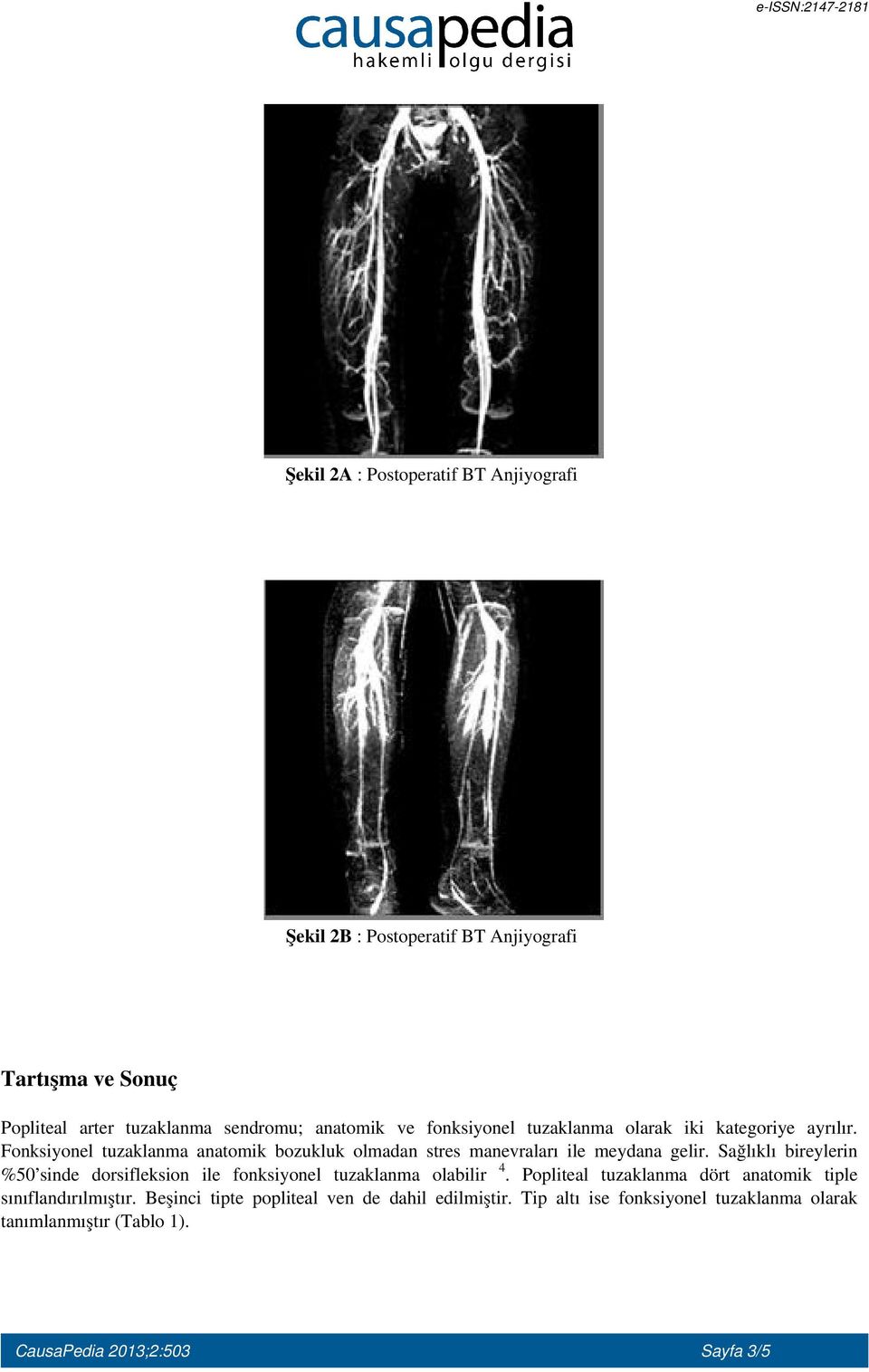 Sağlıklı bireylerin %50 sinde dorsifleksion ile fonksiyonel tuzaklanma olabilir 4. Popliteal tuzaklanma dört anatomik tiple sınıflandırılmıştır.