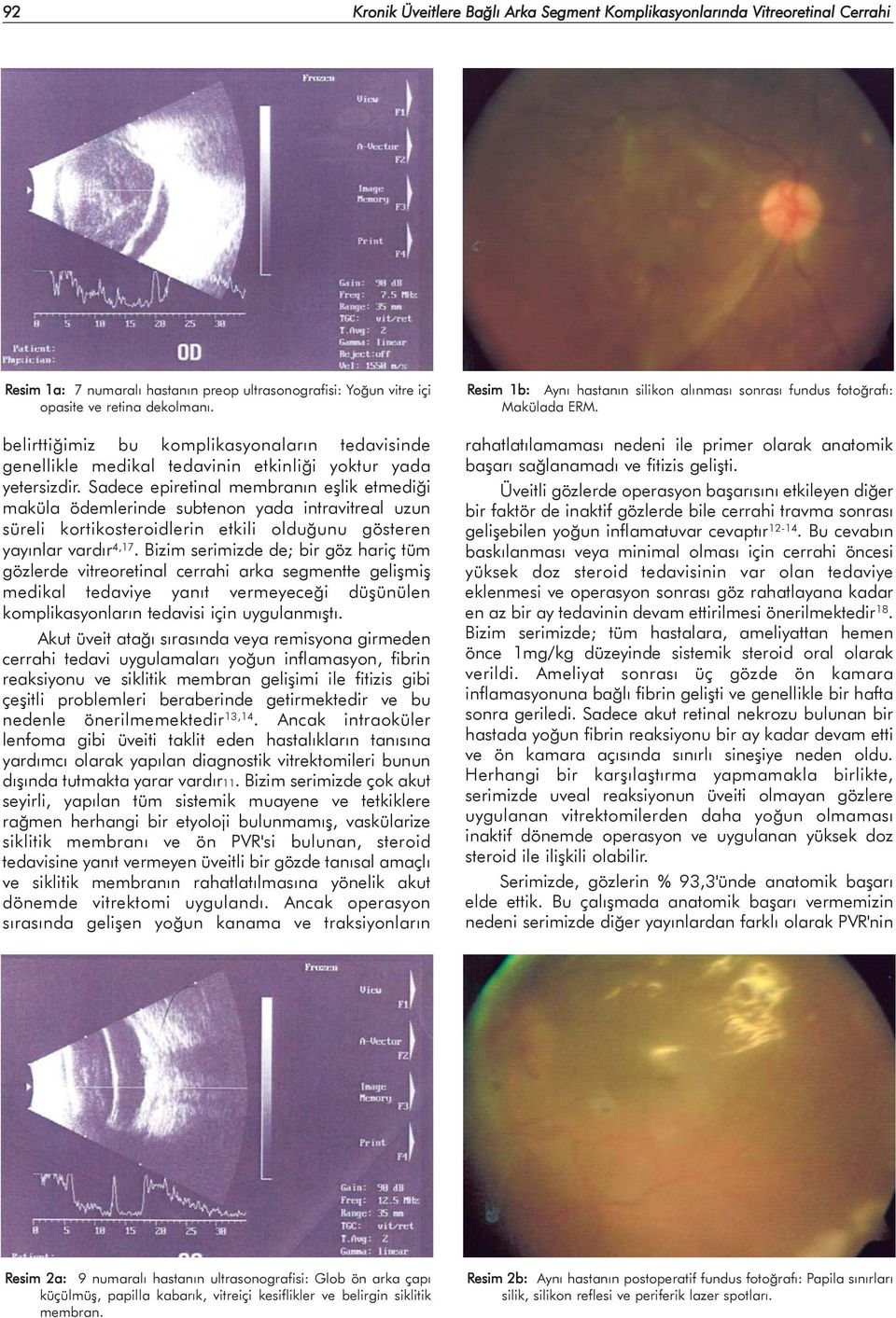 Sadece epiretinal membranýn eþlik etmediði maküla ödemlerinde subtenon yada intravitreal uzun süreli kortikosteroidlerin etkili olduðunu gösteren yayýnlar vardýr 4,17.