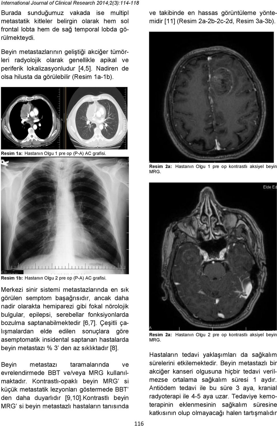 Beyin metastazlarının geliştiği akciğer tümörleri radyolojik olarak genellikle apikal ve periferik lokalizasyonludur [4,5]. Nadiren de olsa hilusta da görülebilir (Resim 1a-1b).