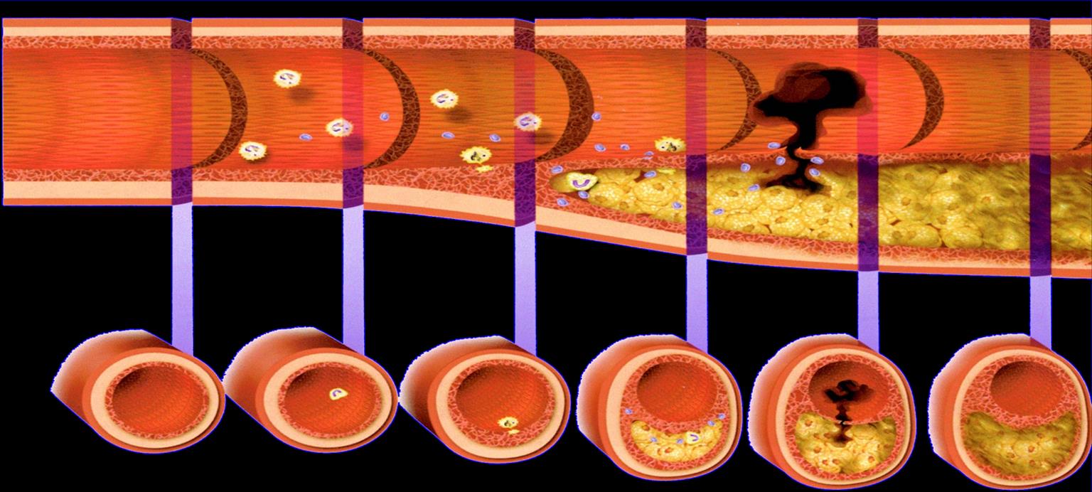 AKS öncesi AKS sonrası 1 2 3 4 5 6 4 Normal arter Subintimal ekstraselüler lipit Yağlı fibröz aşama