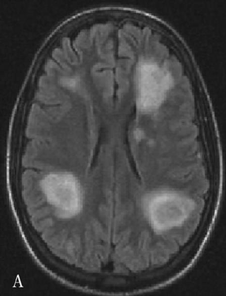 PML MR da tek soliter lezyon olarak başlar, her yeri tutabilir çok sayıda bilateral, asimetrik, kontrast tutmayan demyelinizan lezyonlar