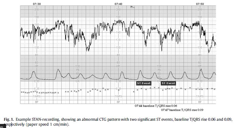 Fetal distressle ilişkili fetal EKG değişiklileri T