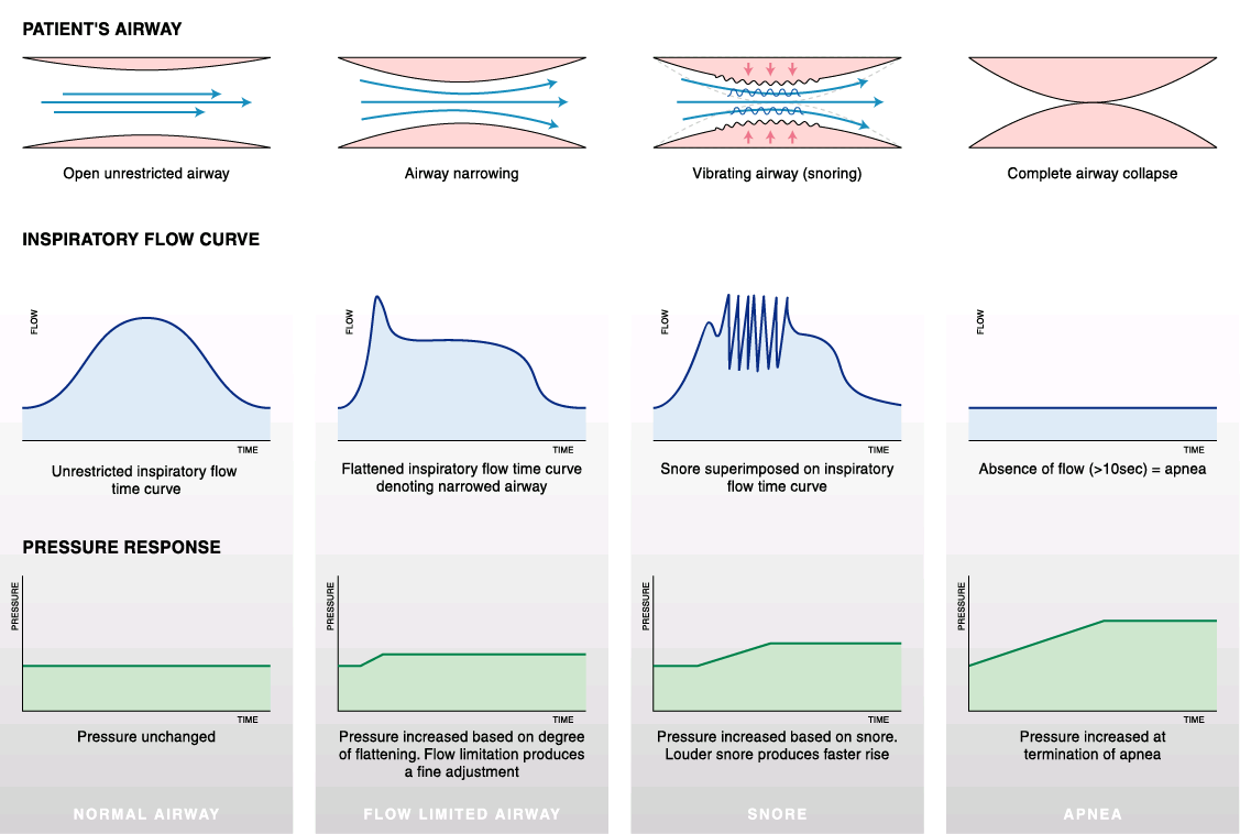 APAP (Autotitrating continuous positive airway pressure) Algoritmaları Normal Havayolu Daralan