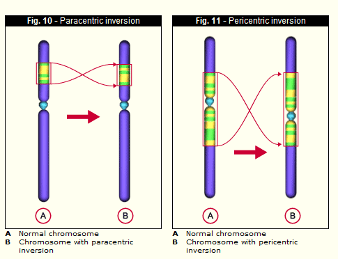 Genetik Faktörler TGK olan çiftlerin %3 5 inde çiftlerden birinde dengeli yapısal kromozomal anomali saptanmakta (çoğu dengeli translokasyon