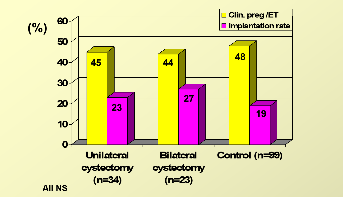 IVF öncesi kistektomi yapmak gebelik oranlarını değiştirmiyor (Tek veya çift