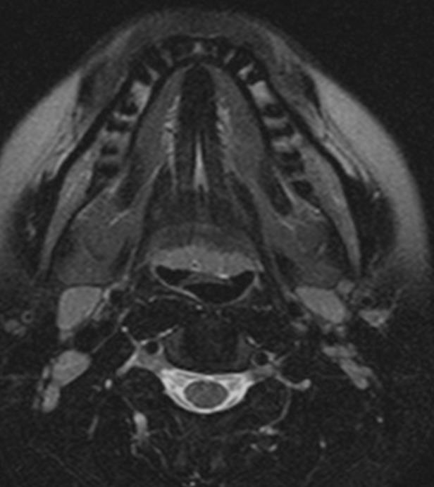 Dil 1/3 posterioru Linguler tonsil Base of tongue Root of