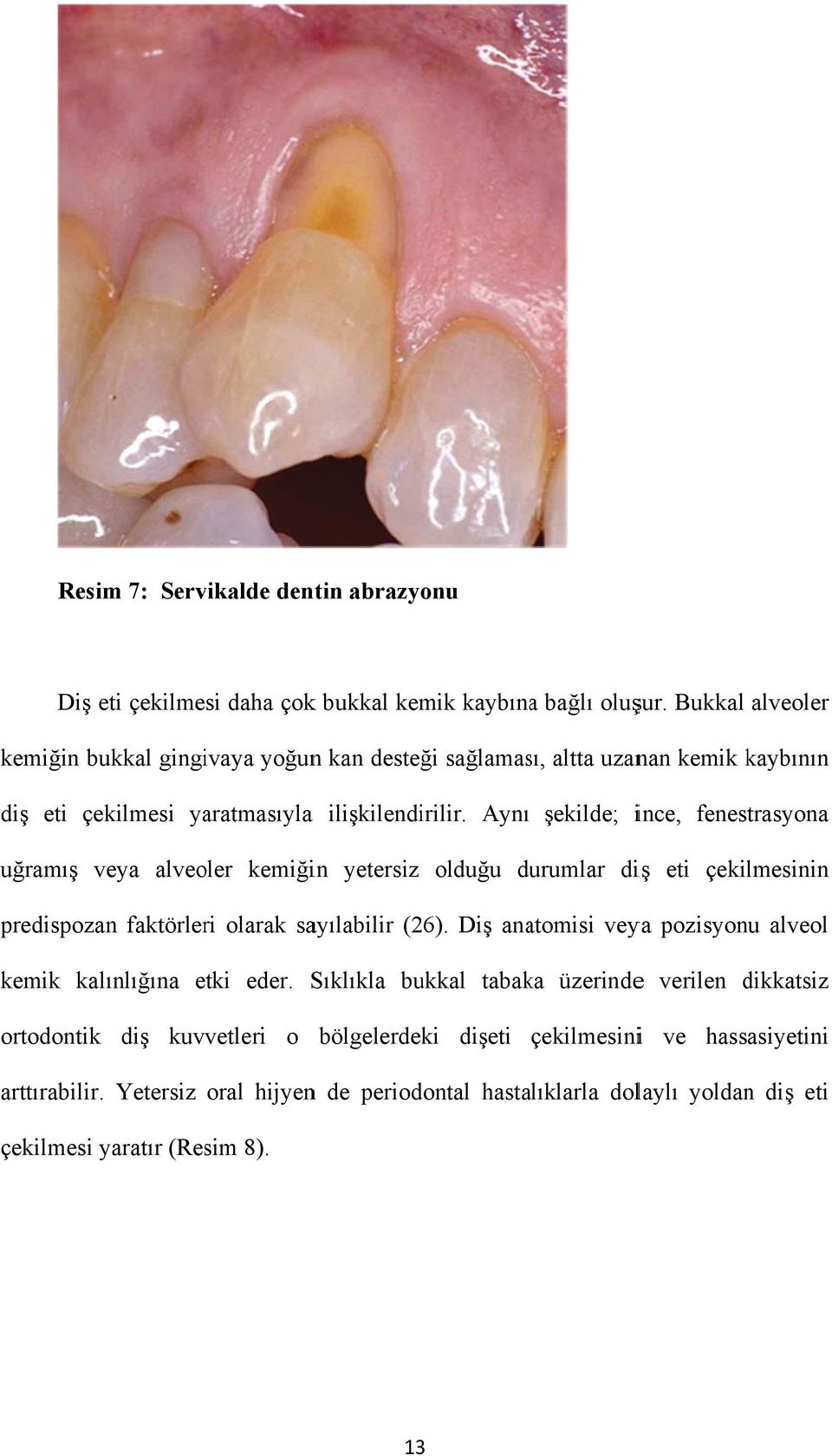 Aynı şekilde; ince, fenestrasyona uğramış veya alveoler kemiğin yetersiz olduğu durumlar diş eti çekilmesinin predispozan faktörleri olarak sayılabilir (26).