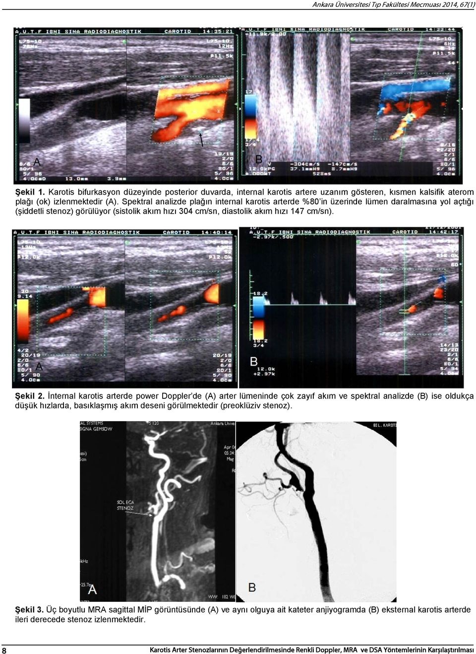 Spektral analizde plağın internal karotis arterde %80 in üzerinde lümen daralmasına yol açtığı (şiddetli stenoz) görülüyor (sistolik akım hızı 304 cm/sn, diastolik akım hızı 147 cm/sn). Şekil 2.