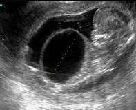 Hf USG Nicolaides KH, Fetal Diagn Ther 2011;29:183-96