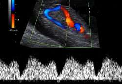 11-14 Hf Tarama Hedefler Fetal anomaliler Preeklampsi Fetal büyüme kısıtlılığı