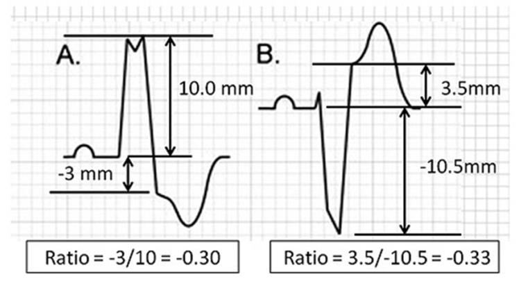 Sgarbossa